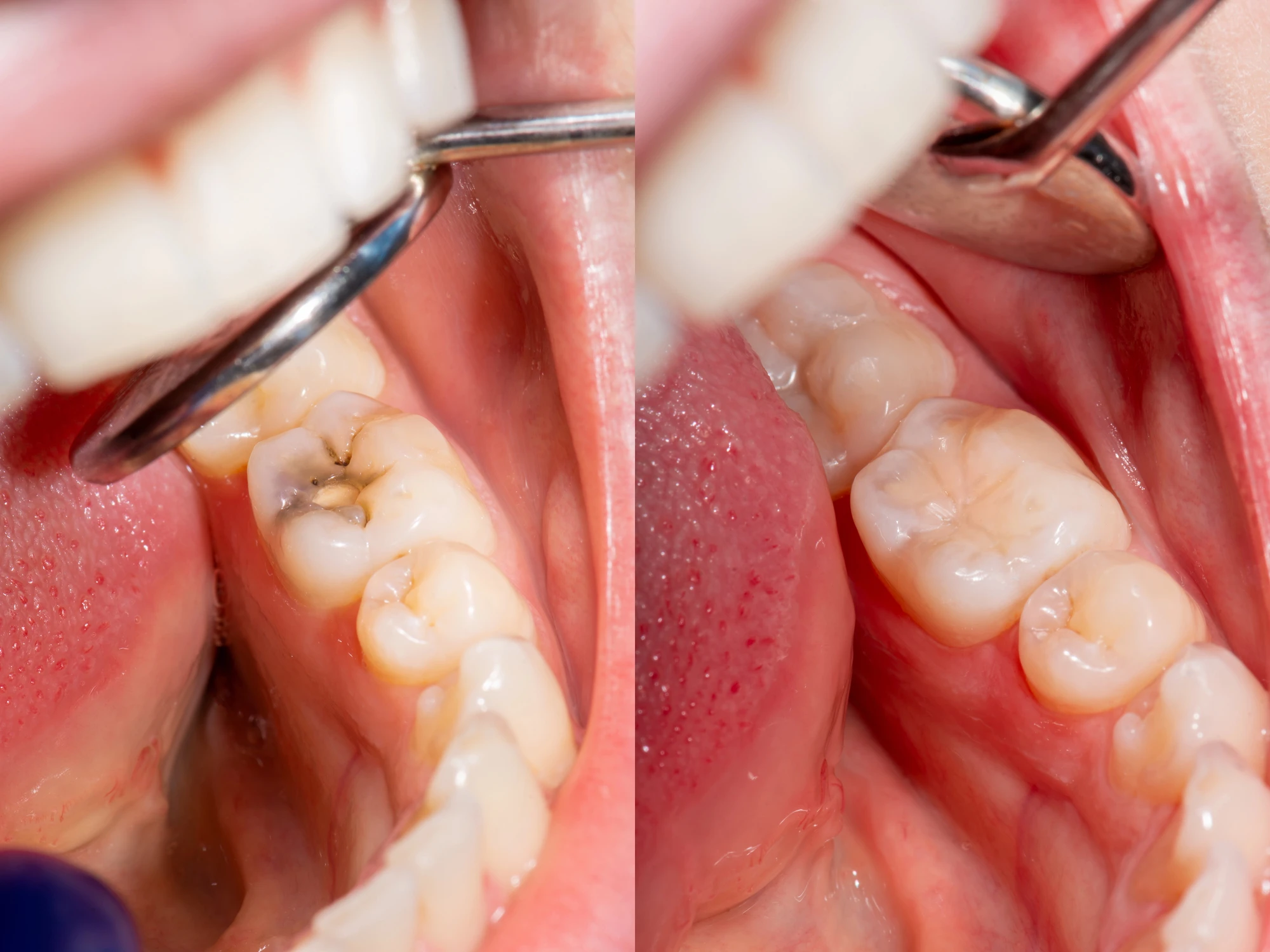 Actual cavity formation that needs expertise of a general dentist in Arlington, VA