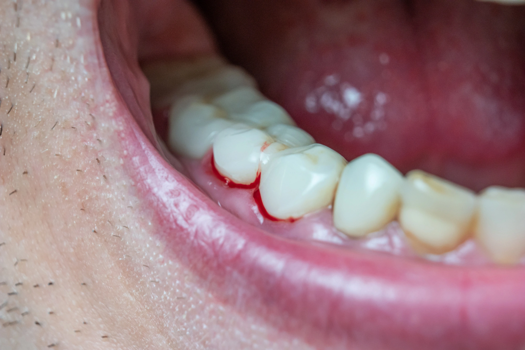 How A General Dentist Helps Prevent Cavities &# ; Gum Disease