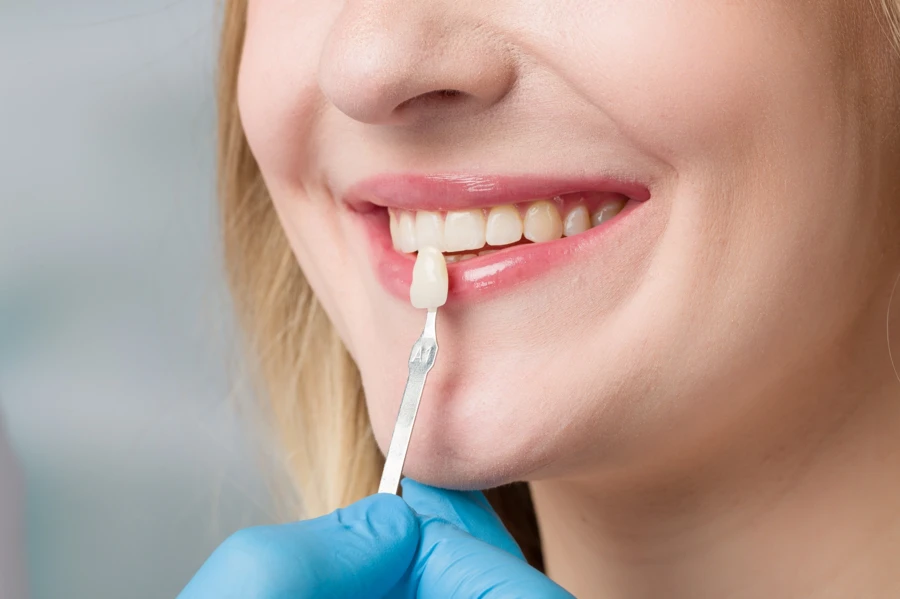 The Benefits Of Porcelain Veneers And Other Cosmetic Treatments