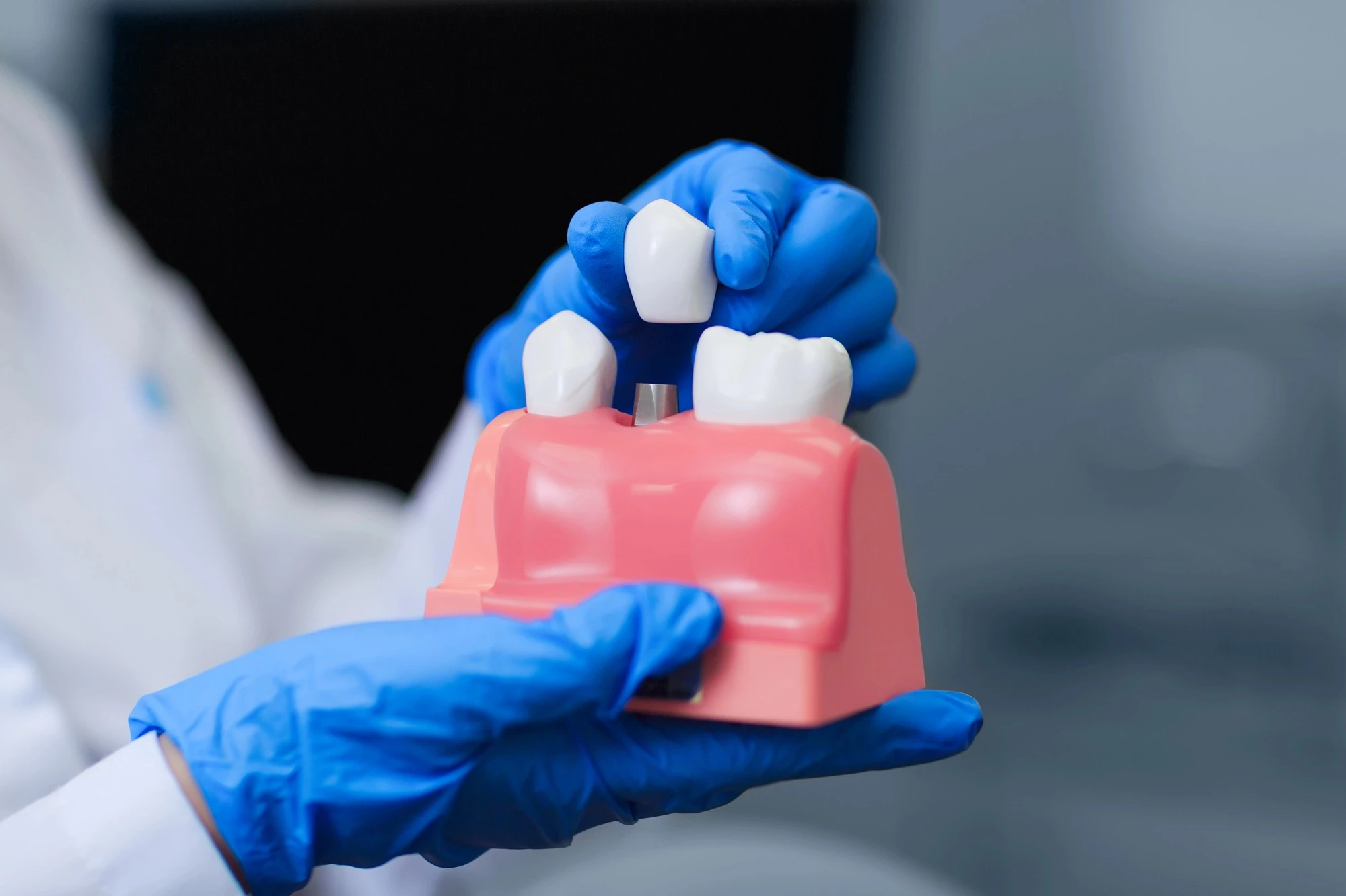 How Dental Implants Restore Strength, Stability, And Smile Function