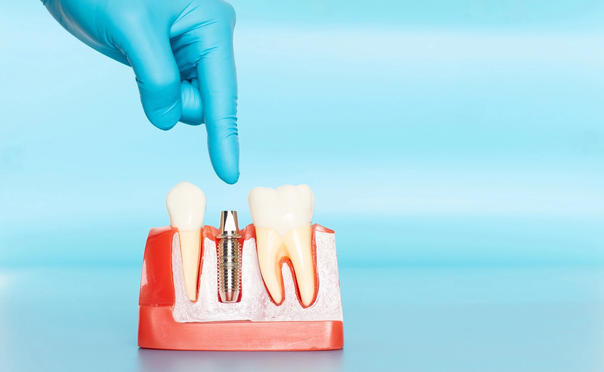 dental implants arlington va implant model