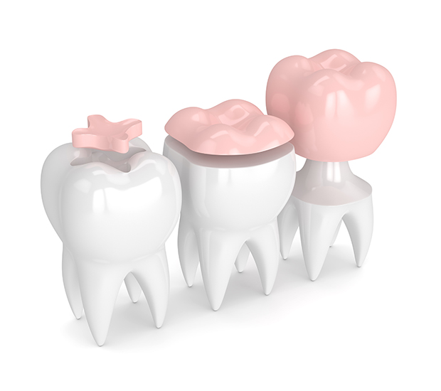 Arlington Dental Inlays and Onlays
