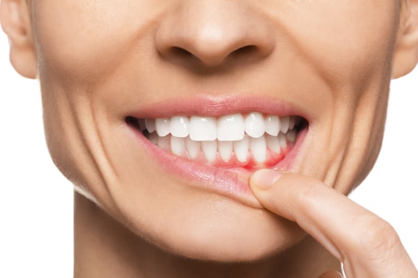 Treating Gum Disease If You Have Gingivitis