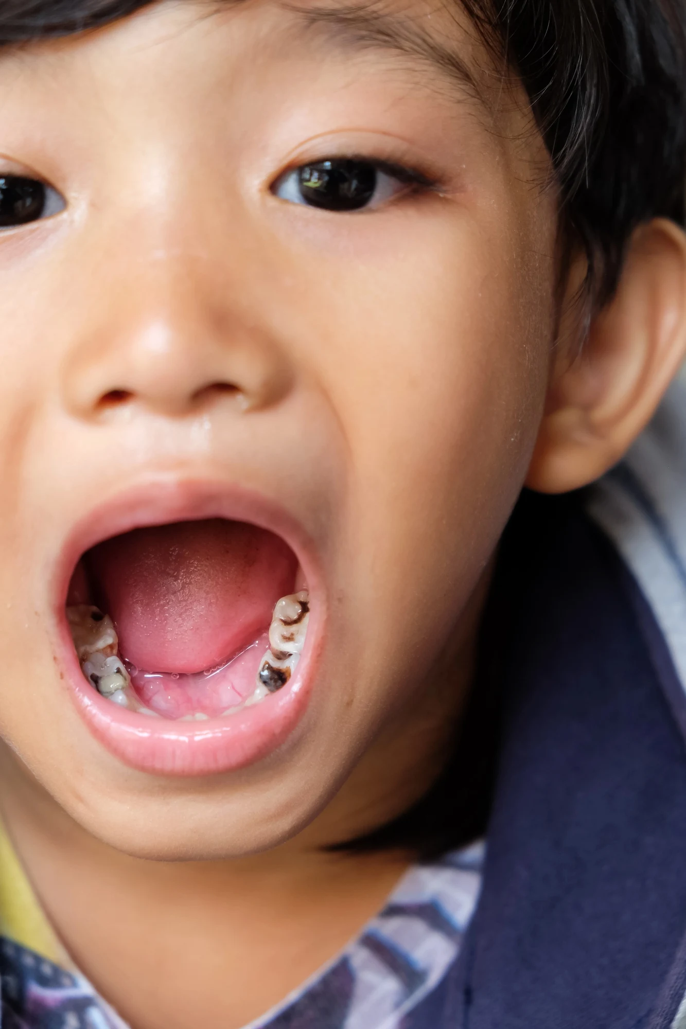 tooth cavity in child and how a professional a general dentist in Arlington, VA can help